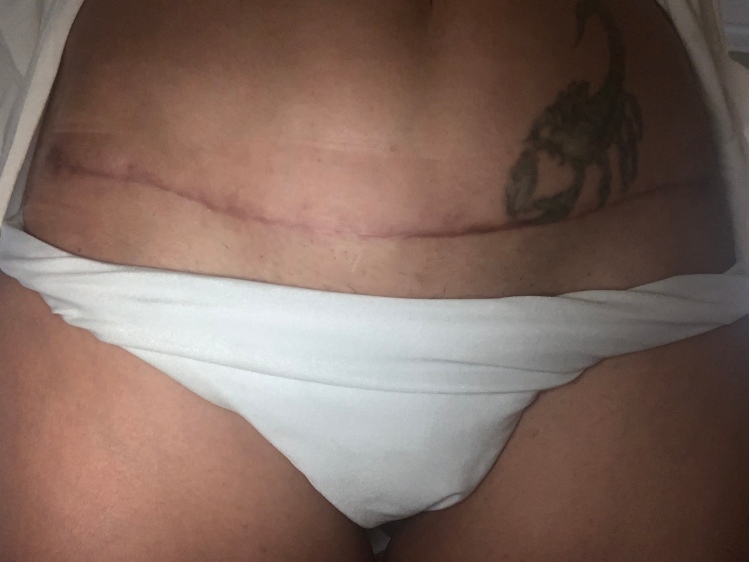 real self tummy tuck – Bad plastic surgery by Dr Shelby Brantley
