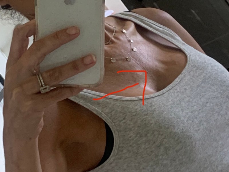 Dr shelby Brantley lied to his patient !Got my mammogram&nbsp;results